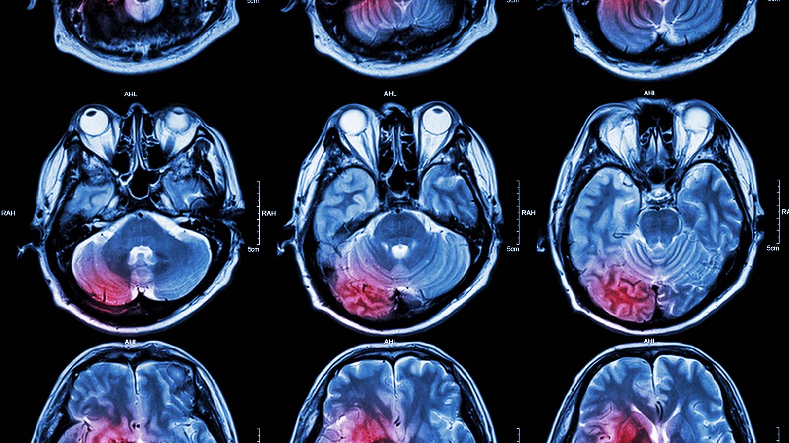 MRI scans of traumatic brain injuries